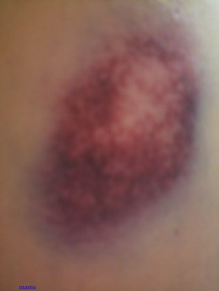 旦那にどつかれました 写あり