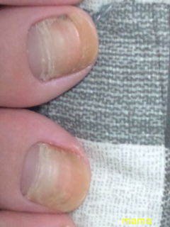 親指の爪に横線が…(ｸﾞﾛい写メ有り、閲覧注意)