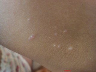 水いぼでしょうか？