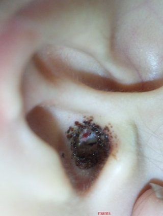 ３才、耳の中から出血