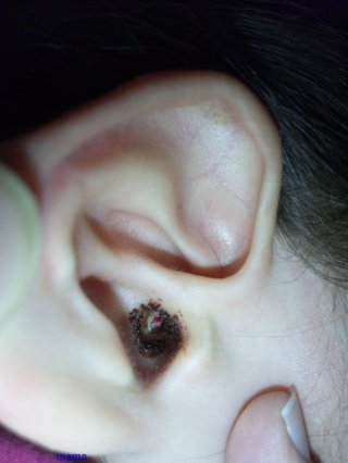 ３才、耳の中から出血