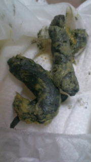 ◆赤ちゃんの難病「胆道閉鎖症」◆