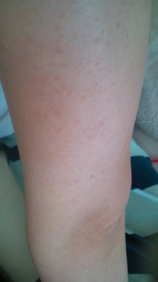 二の腕のぶつぶつ！写あり