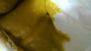 ◆赤ちゃんの難病「胆道閉鎖症」◆