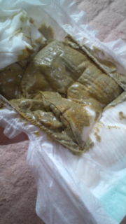 ◆赤ちゃんの難病「胆道閉鎖症」◆