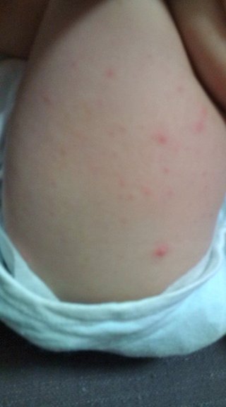 なんの病気？ﾌﾞﾂﾌﾞﾂ写メあり。