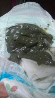 ◆赤ちゃんの難病「胆道閉鎖症」◆