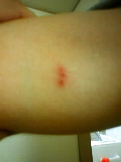 虫刺され？ムカデ？