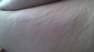 ひどいセルライト