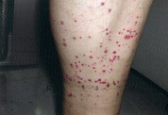 【南京虫】招かれざる客【トコジラミ】