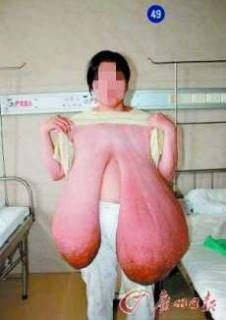 真剣に悩んでます巨乳症(写)