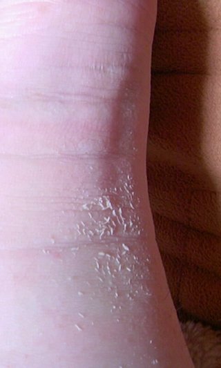 (写)風呂上がりに足のｶｶﾄを掻いたら･･･&#x{12:F7F5};