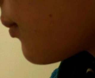 法令線と口角が繋がらへん！