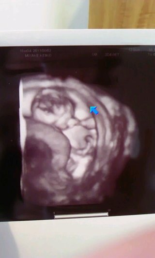 エコー写真…浮腫(;_;)