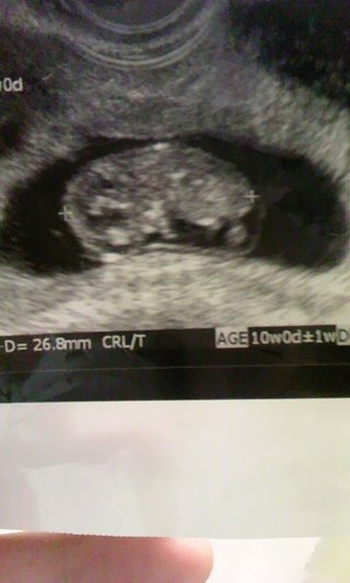 エコー写真…浮腫(;_;)
