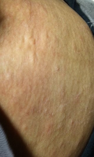 妊娠線が痒くなる、赤いﾌﾞﾂﾌﾞﾂ（ｸﾞﾛ写）