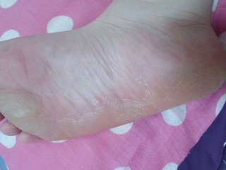 【汚注意・写】これは水虫ですか？