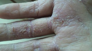 こんな手荒れの方います？