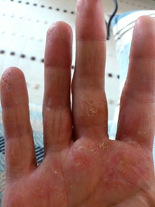 こんな手荒れの方います？