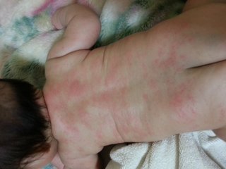 アセモ……？？