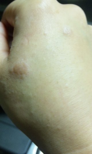 手の甲が痒い…主婦湿疹？写あり