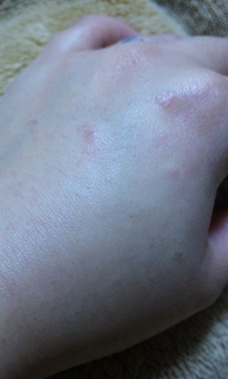 手の甲が痒い…主婦湿疹？写あり