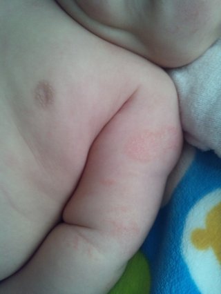 3ヶ月赤ちゃん　二の腕がカサカサ