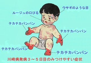 子供に多い“川崎病”６つの症状見逃すな！