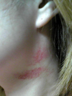 首をしめられ内出血