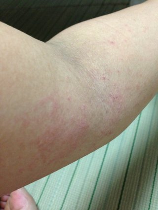 汗疹？辛すぎる【写あり】