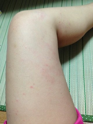 汗疹？辛すぎる【写あり】