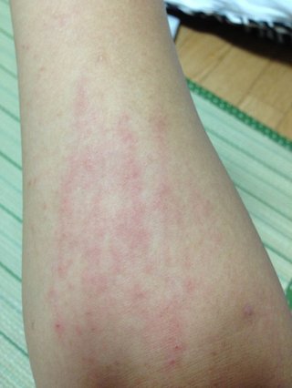 汗疹？辛すぎる【写あり】