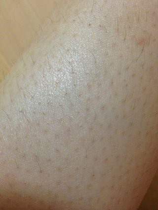 ムダ毛処理による足のこの黒いボツボツ(写)