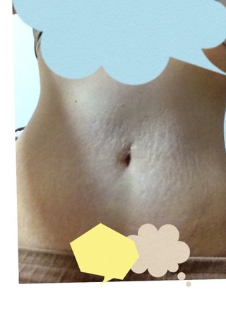 痩せました。妊娠線…