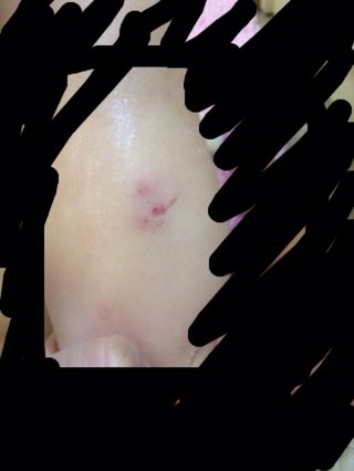 子供が保育園で腕を噛まれたら