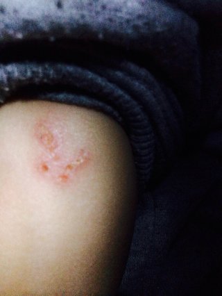 子供が保育園で腕を噛まれたら