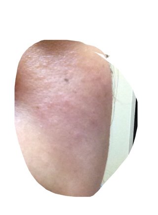 (汚)頬のぼこぼこ…助けて下さい。