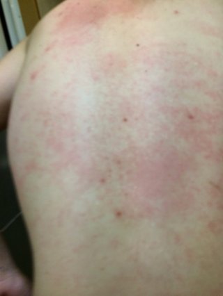 首のつけね～肩、胸の上あたりばかり湿疹ができる