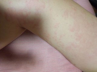 ５年生、蕁麻疹。