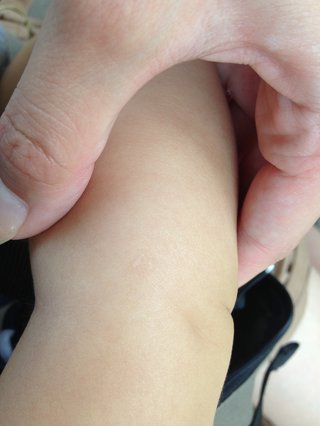 白斑ある人！これって白斑ですか？