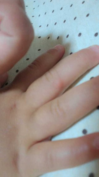 虫刺され 増える