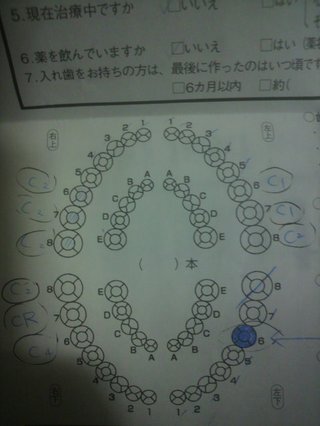 【歯医者怖い】親知不・虫歯【勇気を下さい】