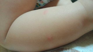 虫刺され 増える