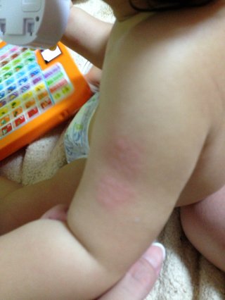 BCGの跡が赤くなっている(画像あり