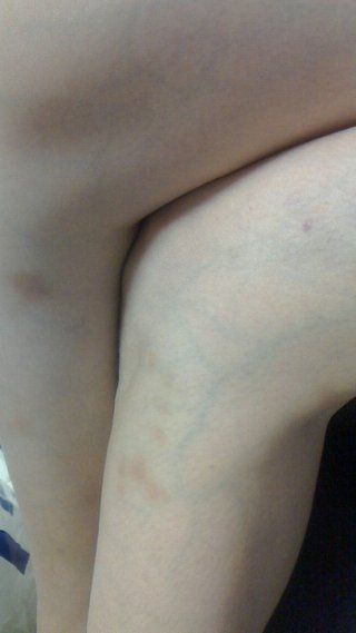 噛む行為もＤＶに入りますか？