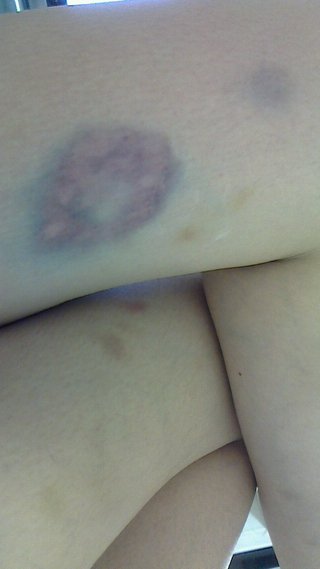 噛む行為もＤＶに入りますか？