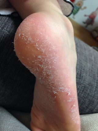 子どもの水虫？