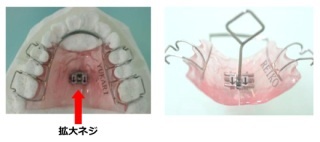 小児矯正について