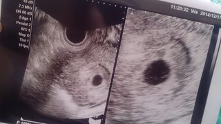 8w4dのエコー写真なのですが…