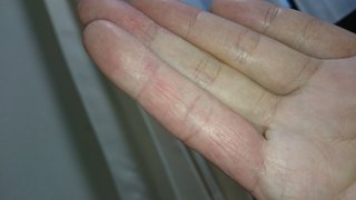 主婦湿疹【汚写あり】